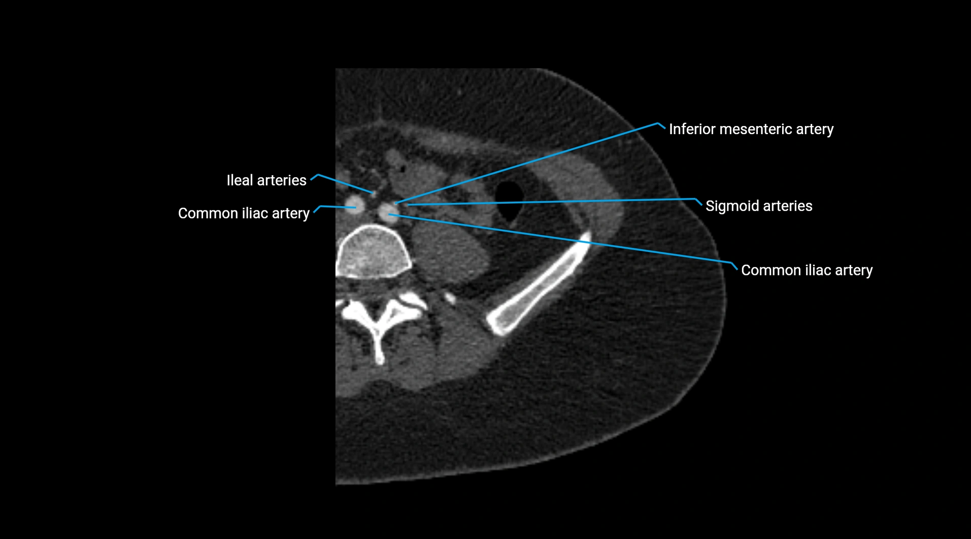 CTA lower limb cross sectional anatomy labelled image _6.webp